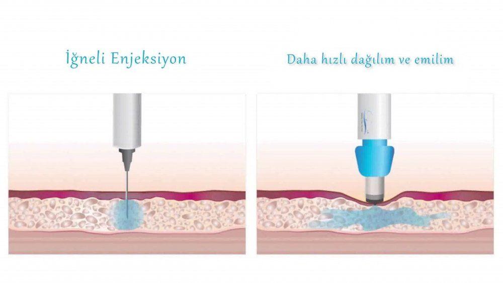 Saç ekiminde ağrısız yöntem, sağlık turizmde artış sağladı
